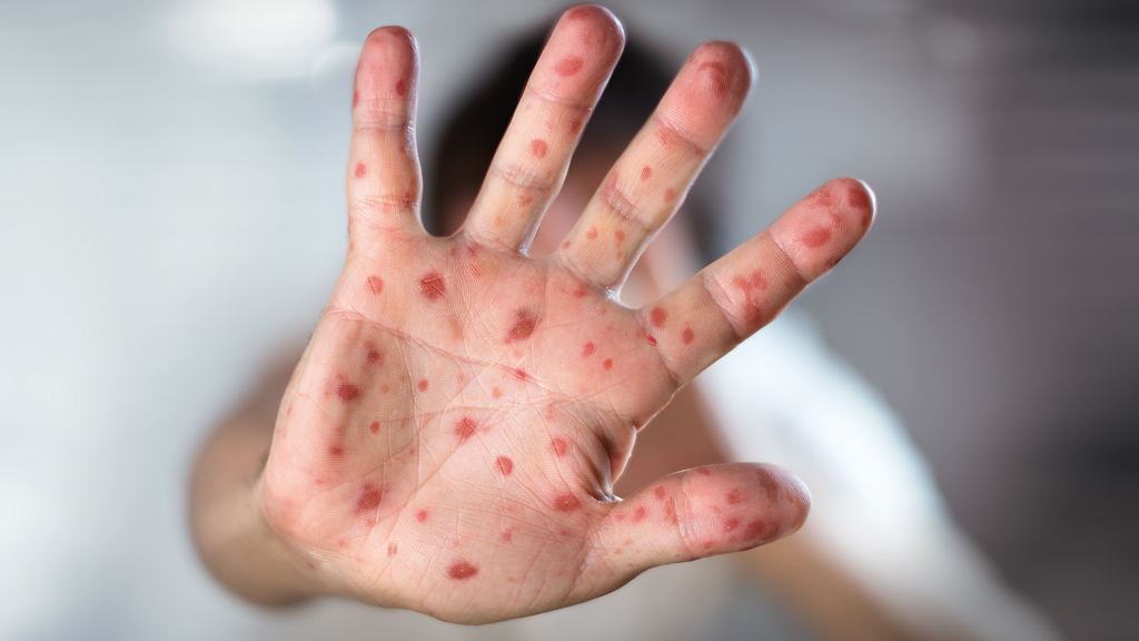 Mano con heridas de sarampión