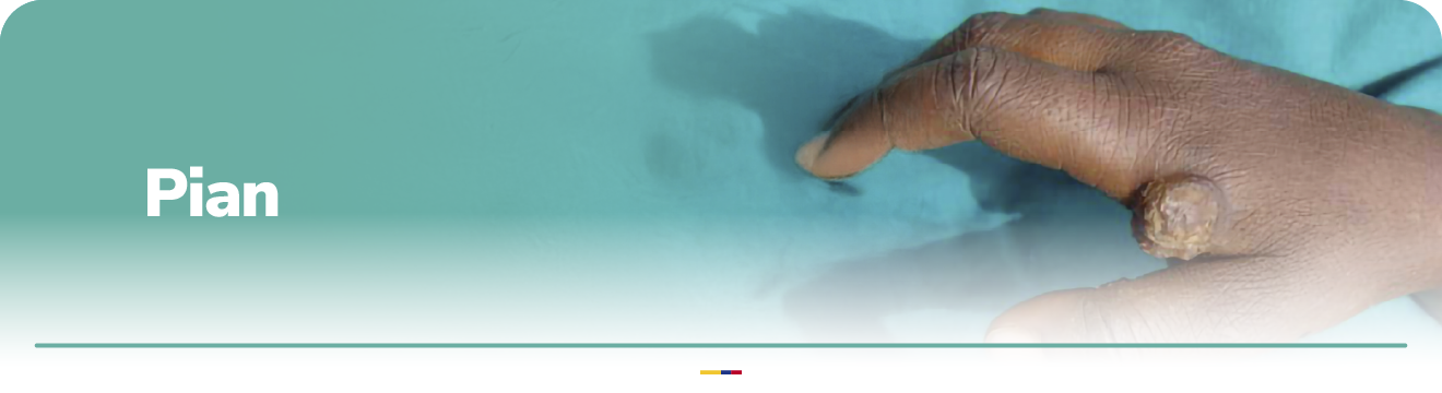 lesión inicial de frambesia en piel de persona africanas en la mano.