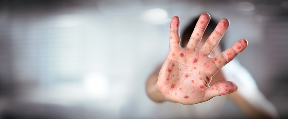 Una mano con salpullido referente al sarampión